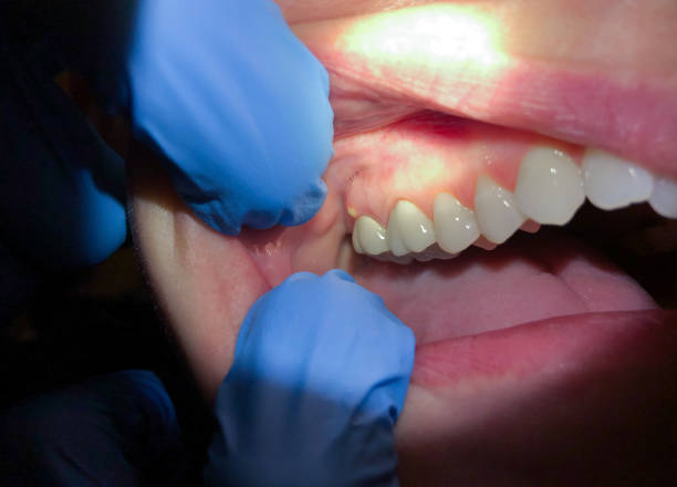Best Knocked-Out Tooth (Avulsed Tooth) Treatment in Deerwood, TX